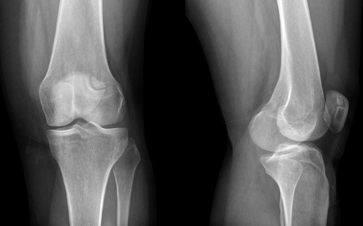 A artrose do xeonllo no x -ray antes do uso de hondroine