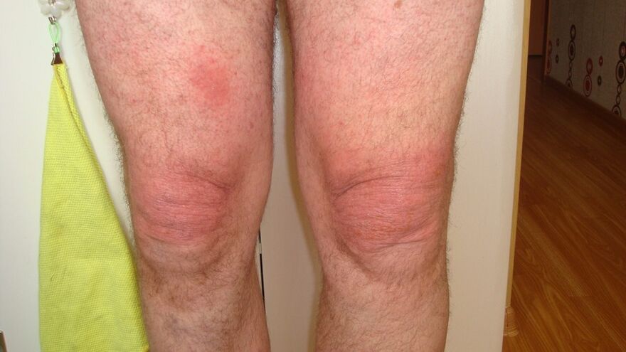 artrose das articulacións do xeonllo